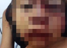 Menino de 2 anos tem rosto desfigurado após ataque de cachorro em São Julião