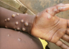 Piauí investiga seis casos suspeitos de varíola dos macacos e Sesapi faz alerta