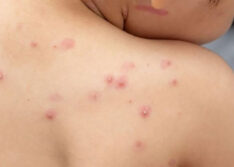 Picos registra primeiro caso de Varíola dos Macacos